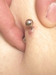 belly button piercing bump
