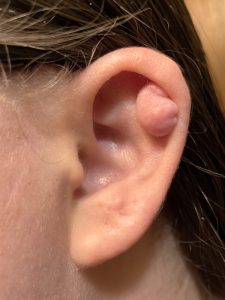 ear piercing keloid